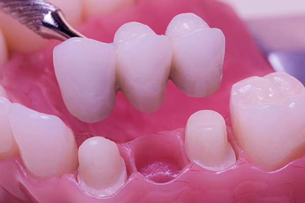 The Importance of Replacing Missing Teeth: How Dental Bridges Can Help in Buffalo Grove