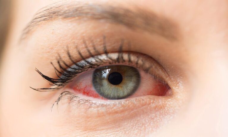 Dry Eyes Treatment: Safeguarding Your Eyes Against Vision Problems